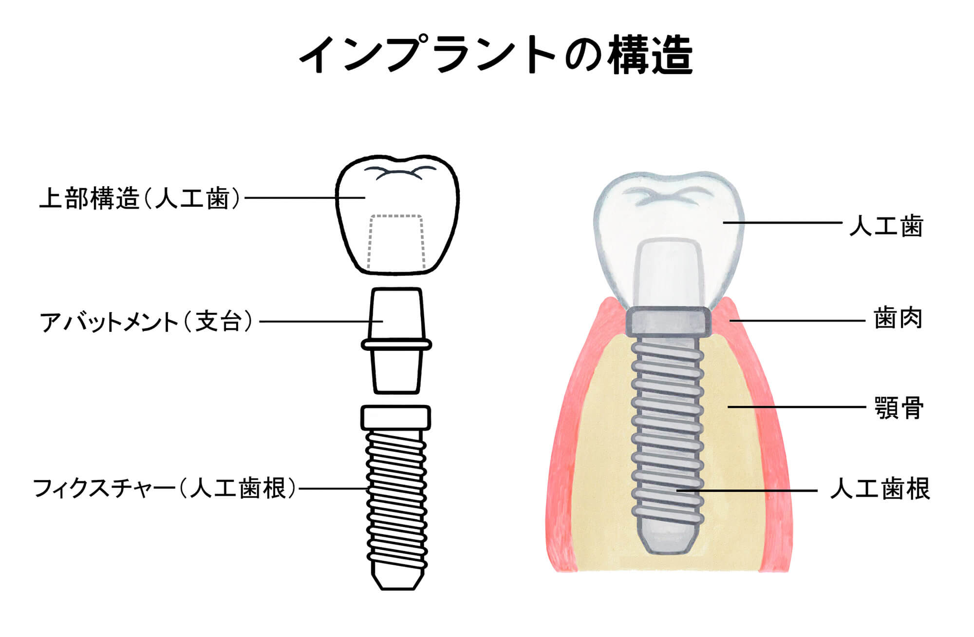 インプラントの構造（イラスト）